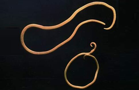 parasitic worms from the human body