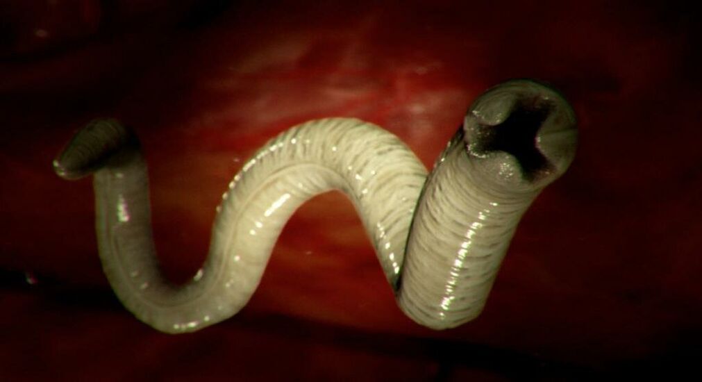 worms from the human body